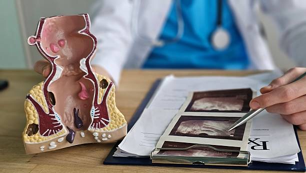 Fistula Surgery: What to Expect Before and After Treatment